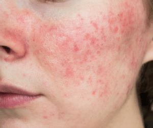 Rosacea Skin image